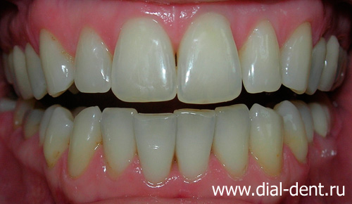 реставрация дефектов зубов и лазерное отбеливание зубов