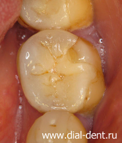 многократно леченый зуб
