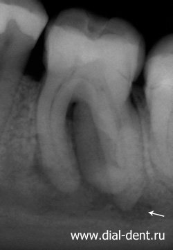 прицельный рентген зуба