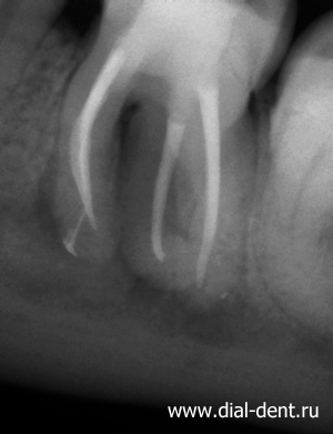 запломбированные каналы зуба