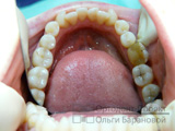 неровно растущие зубы