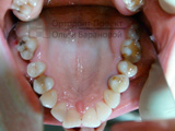 сужение верхнего зубного ряда