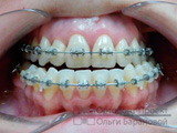 выравнивание зубов с помощью брекет-системы