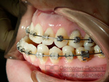 выравнивание зубов с помощью брекет-системы