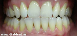 выполнено десять процедур отбеливания зубов