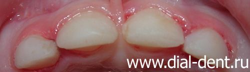 лечение кариеса молочных зубов в "Диал-Дент"