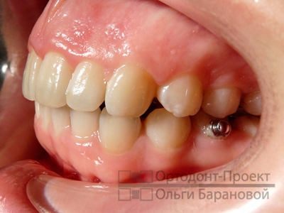 исправление прикуса ортодонтическими эластиками