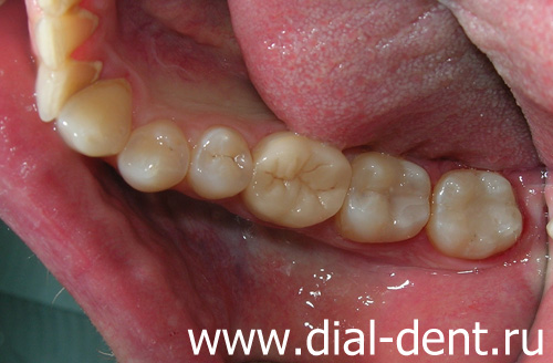 диагностика и лечение кариеса зубов