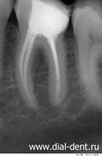 лечение каналов зуба