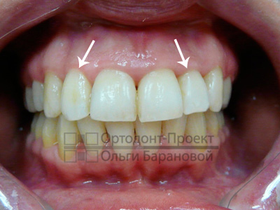 несимметричность передних зубов