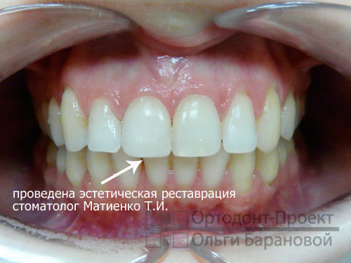 выполнена эстетическая коррекция передних зубов