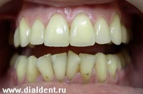 реставрация зубов верхней челюсти
