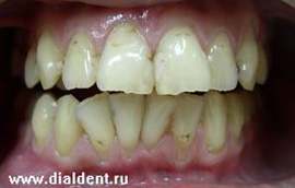 некрасивые зубы до лечения