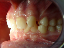 до ортодонтического лечения вид слева