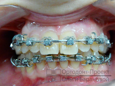 процесс ортодонтического лечения