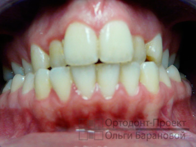 сужение верхнего зубного ряда из-за давно удаленных зубов
