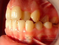 вид слева до лечения у ортодонта