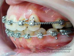 ортодонтическое лечение перед имплантацией зубов