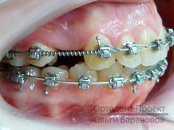 ортодонтическое лечение перед имплантацией зубов