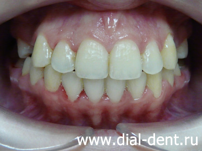после лечения у ортодонта установлены зубные импланты