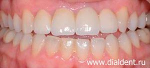 выравнивание зубов, керамические коронки на верхних зубах