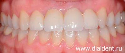 лазерное отбеливание зубов и реставрация керамическими коронками (передние верхние зубы)