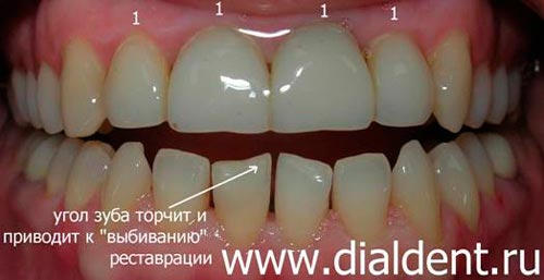 щели между зубами, неустойчивость реставраций верхних зубов