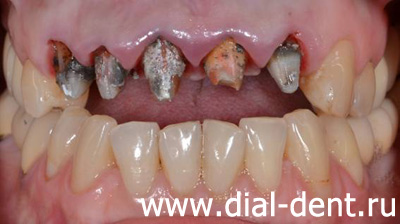 состояние зубов под коронками до лечения