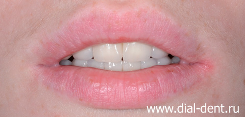 вид зубов после сложного протезирования