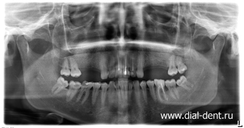 панорамный снимок перед имплантацией зубов