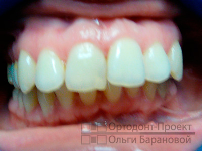 неровные, сильно выпирающие зубы