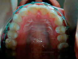 выравнивание зубов брекетами Damon