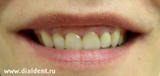 новая улыбка пациентки стоматологической клиники Диал-дент