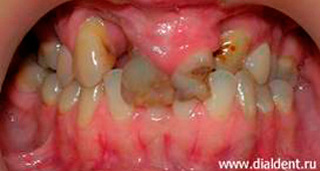 расщелина губы и неба, после операции, но до протезирования зубов