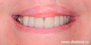 улыбка после протезирования зубов