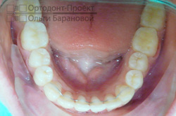 после лечения у ортодонта