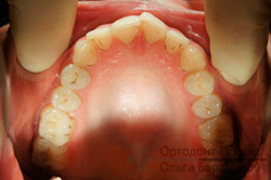 до лечения у ортодонта