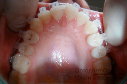 брекеты установлены на зубы верхней челюсти