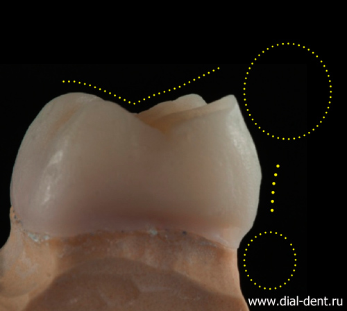 проектирование формы зубной коронки