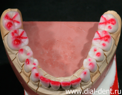 создание восковой модели зубных коронок - нижняя челюсть
