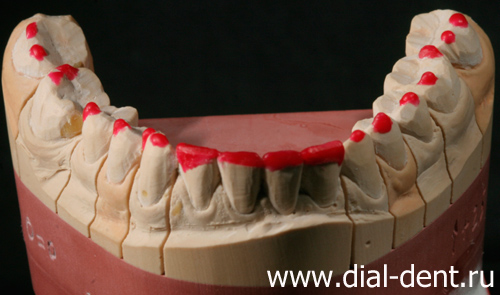 создание восковой модели зубных коронок