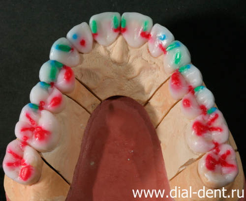 создание восковой модели зубных коронок - верхняя челюсть