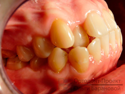 до ортодонтического лечения - фотометрия