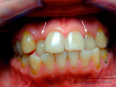 до ортодонтического лечения - фотометрия