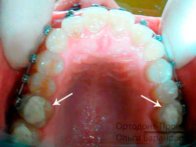 ортодонтические накладки