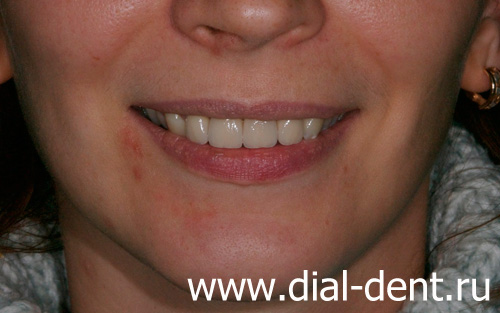 улыбка после протезирования передних зубов в "Диал-Дент"