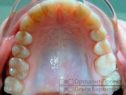 результат лечения у ортодонта