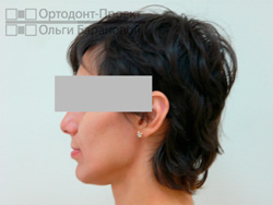 профиль после лечения глубокой окклюзии