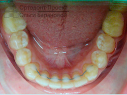 результат ортодонтического лечения, нижняя челюсть