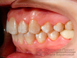 результат ортодонтического лечения, вид слева